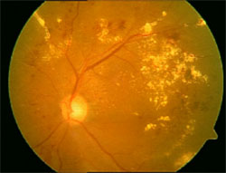 糖尿病视网膜病变