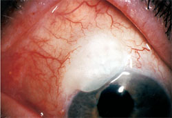 小梁切除效果图