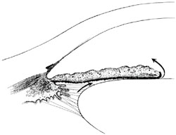原发性开角型青光眼