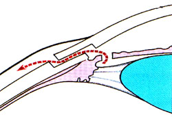 小梁切除示意图
